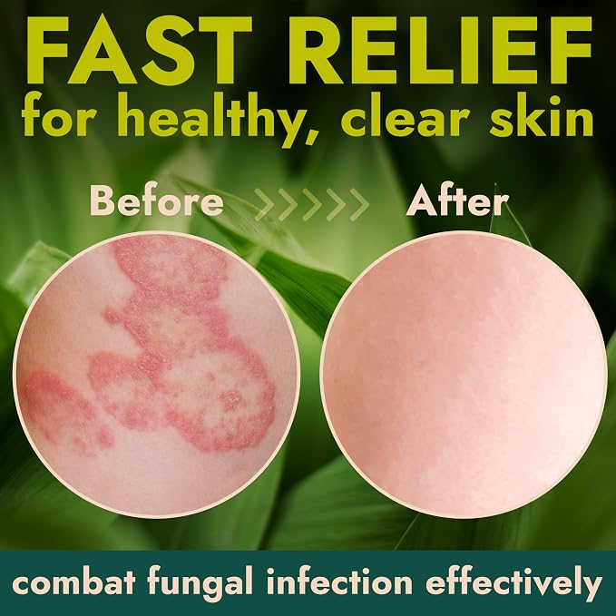 Antifungal Body Cream for Ringworm & Athlete’s Foot | Strength Formula - Image 5